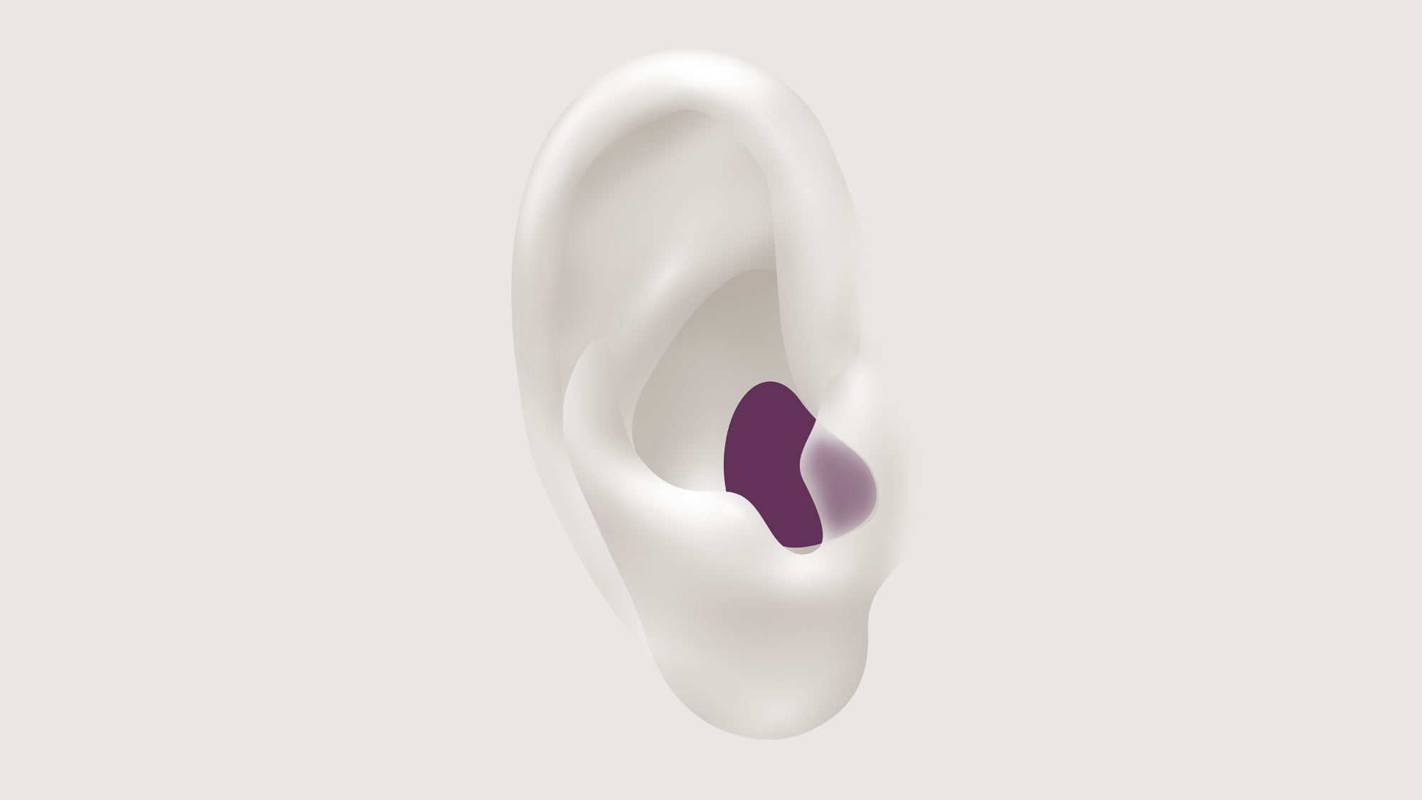 Illustration showing the types of hearing aid called ITE which is worn in the canal.