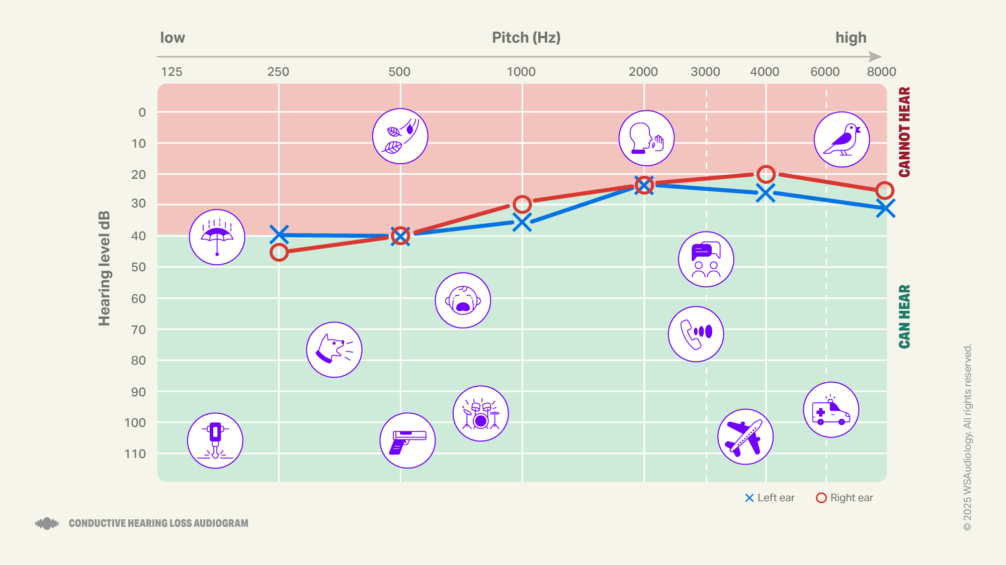 Conductive hearing loss audiogram