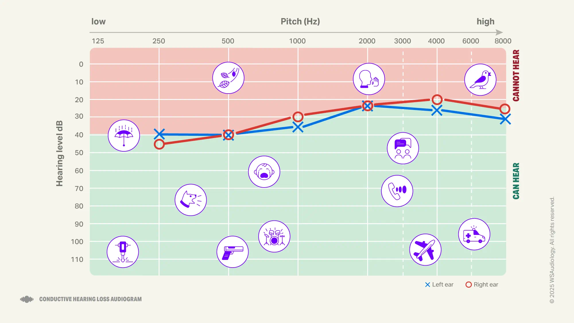 Conductive hearing loss audiogram
