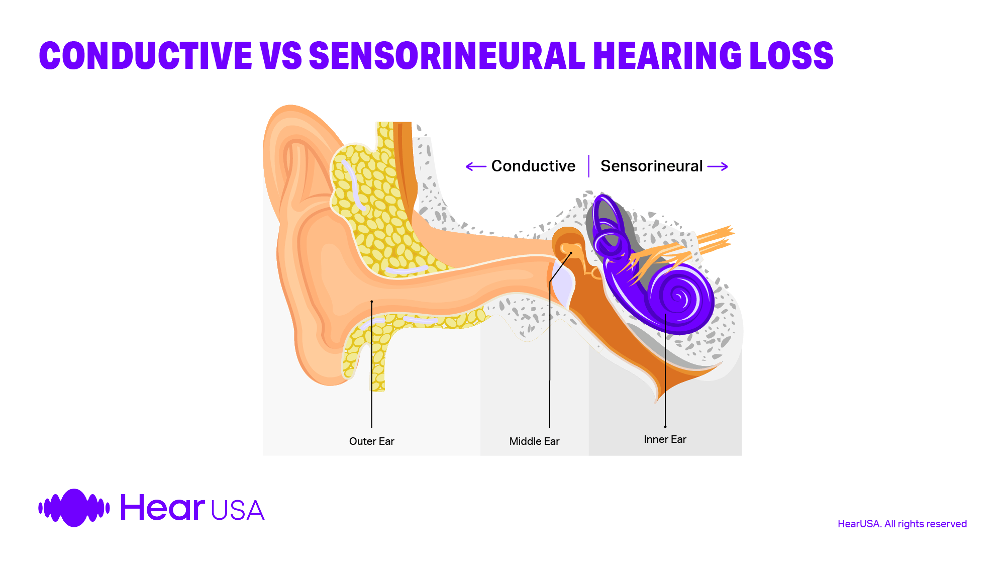 Wheter you have a conductive or sensorineural hearing loss hearing aids can help your hearing
