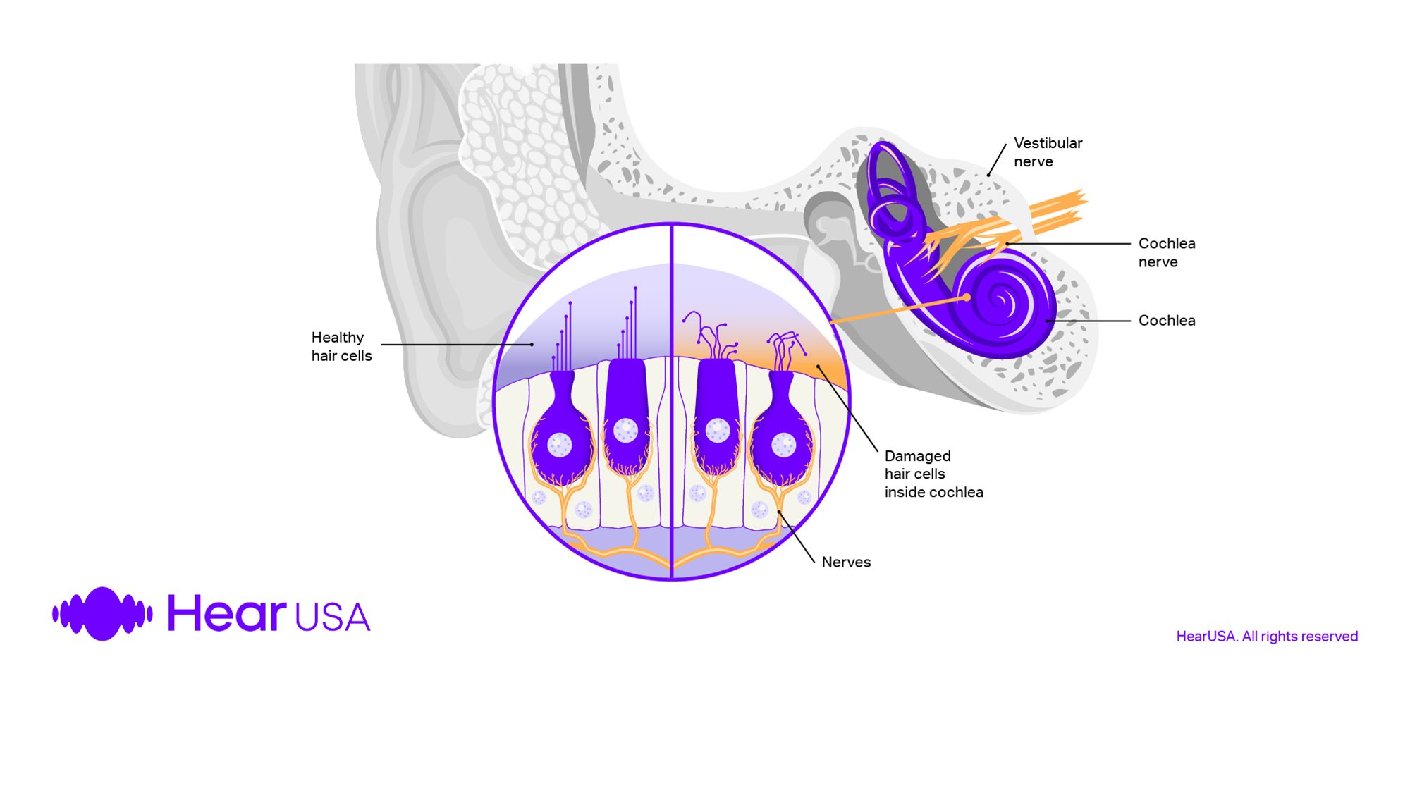 When the hair cells in your inner ear are damaged i causes a hearing loss but hearing aids can help