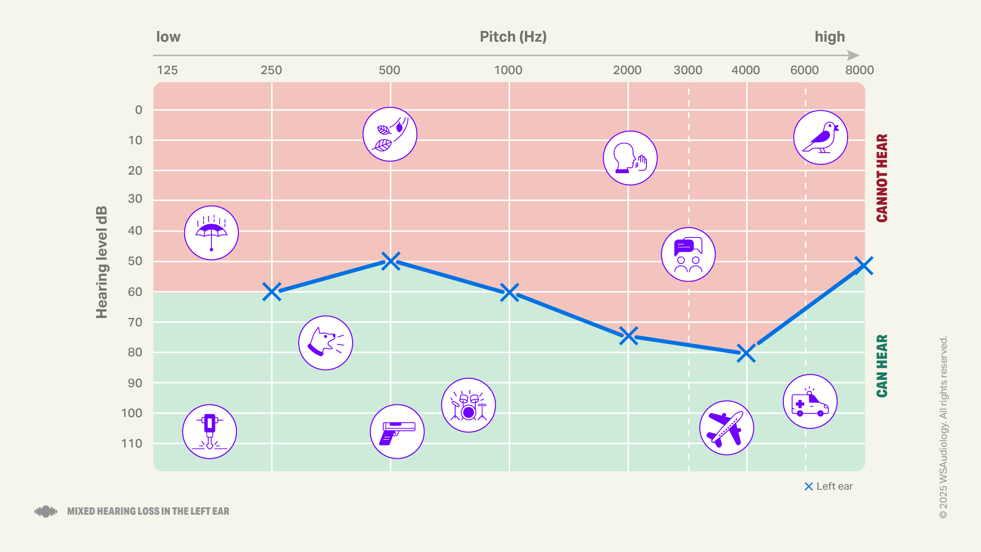 Mixed hearing loss audiogram
