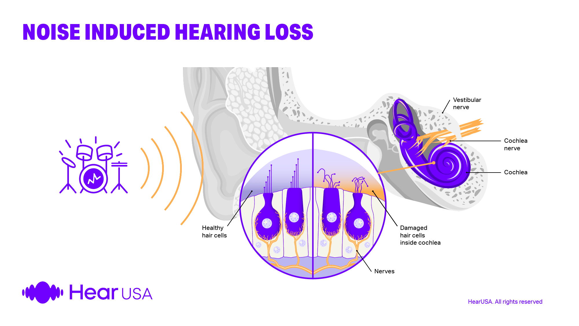 Hearing loss caused by being exposed to noise can be helped by wearing hearing aids