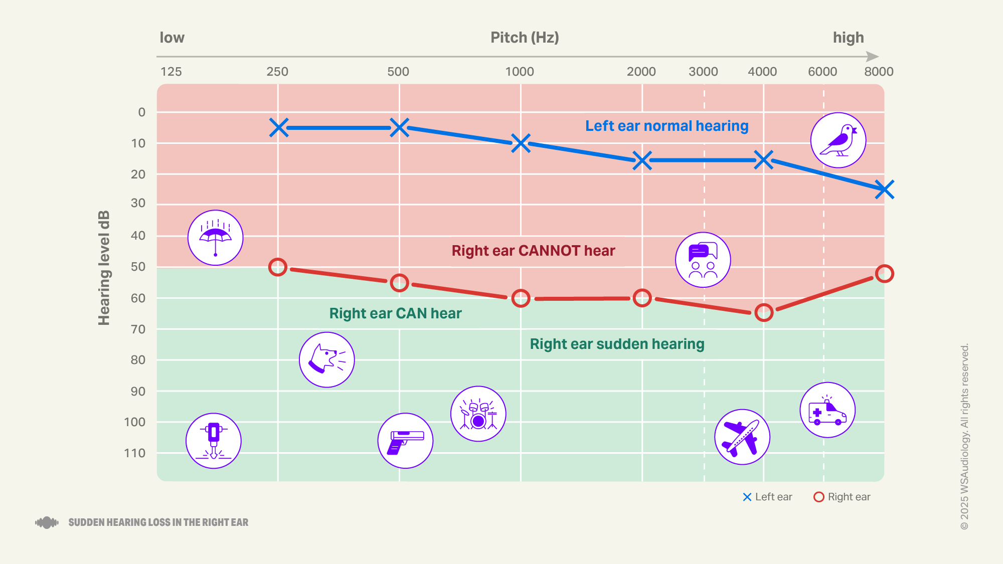 Sudden hearing loss right ear audiogram