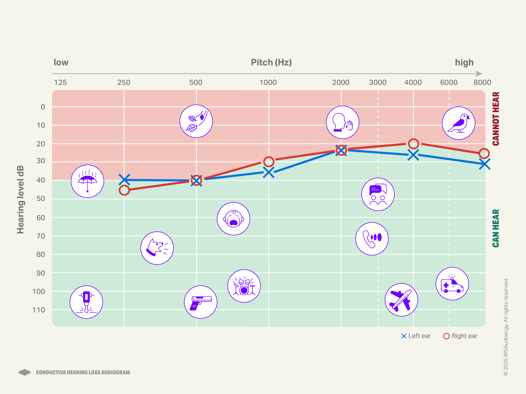 Conductive hearing loss audiogram
