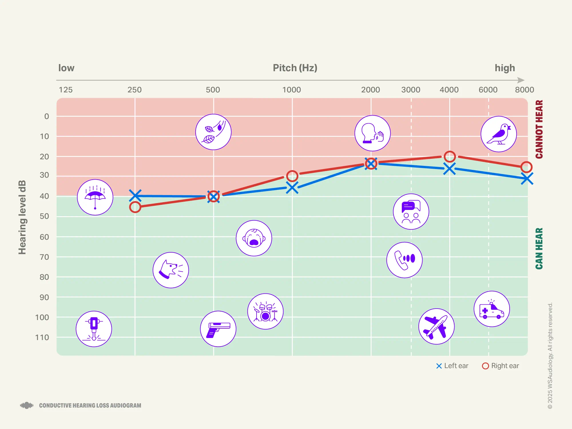 Conductive hearing loss audiogram