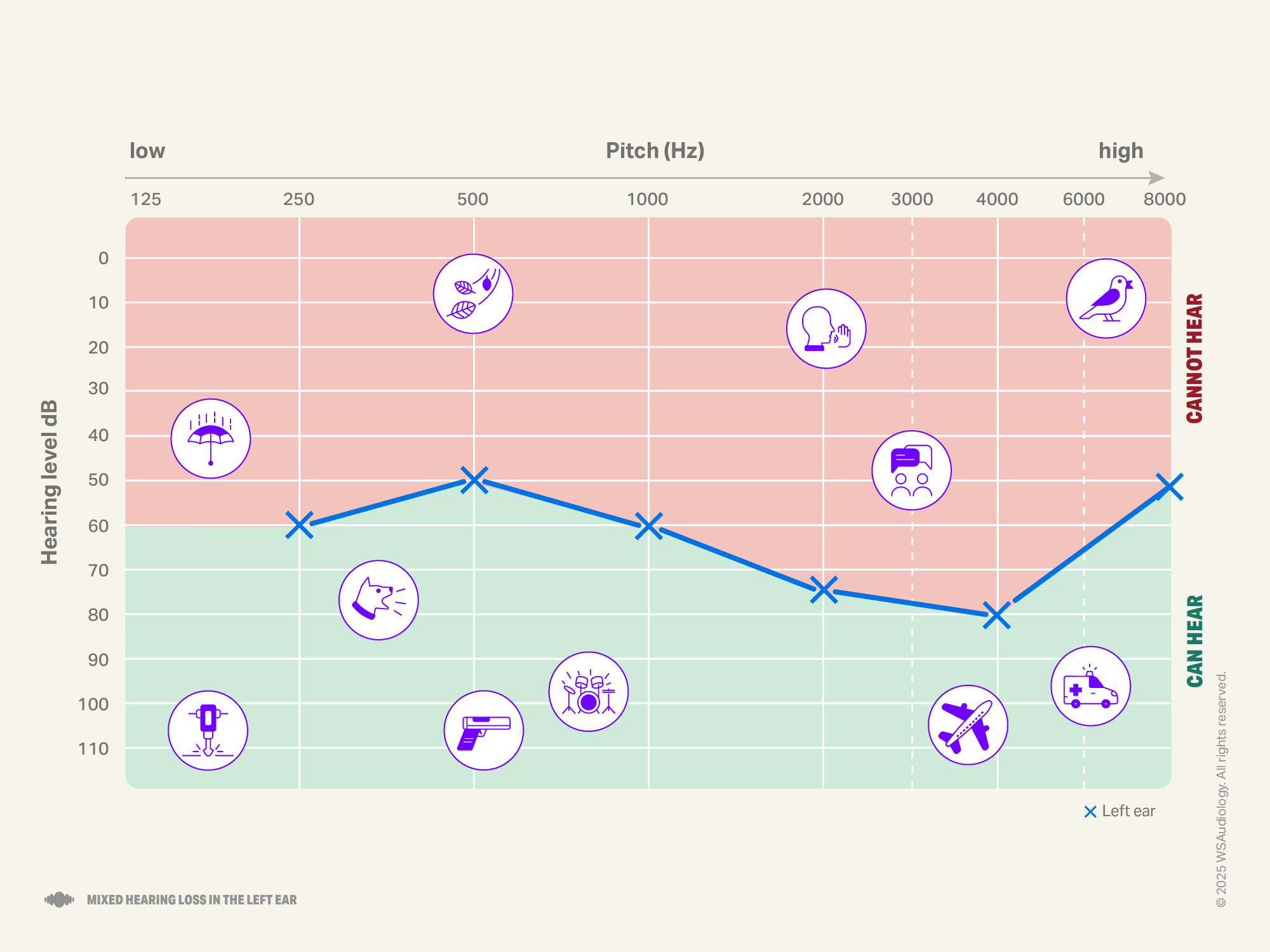 Mixed hearing loss audiogram