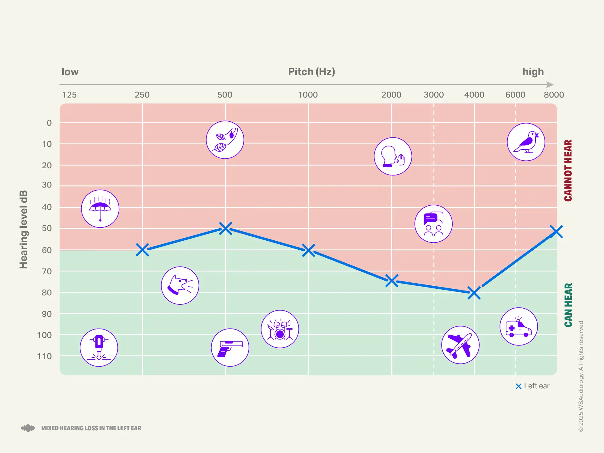 Mixed hearing loss audiogram