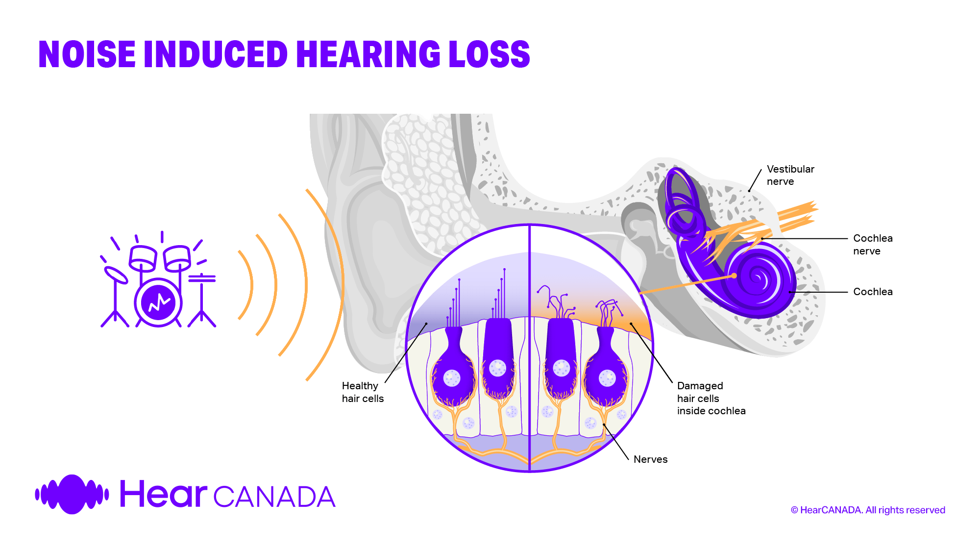 Noise induced hearing loss