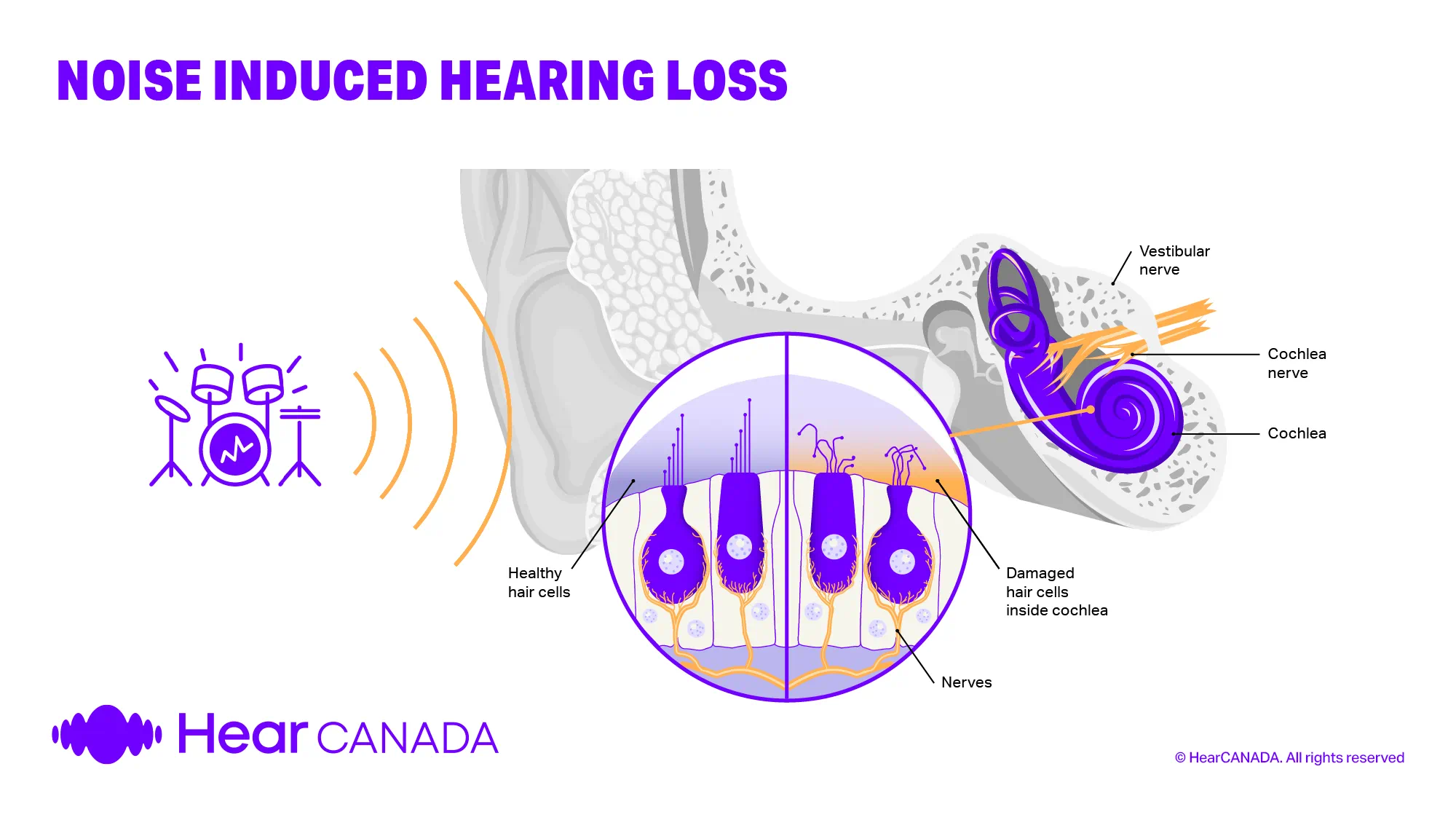 Noise induced hearing loss