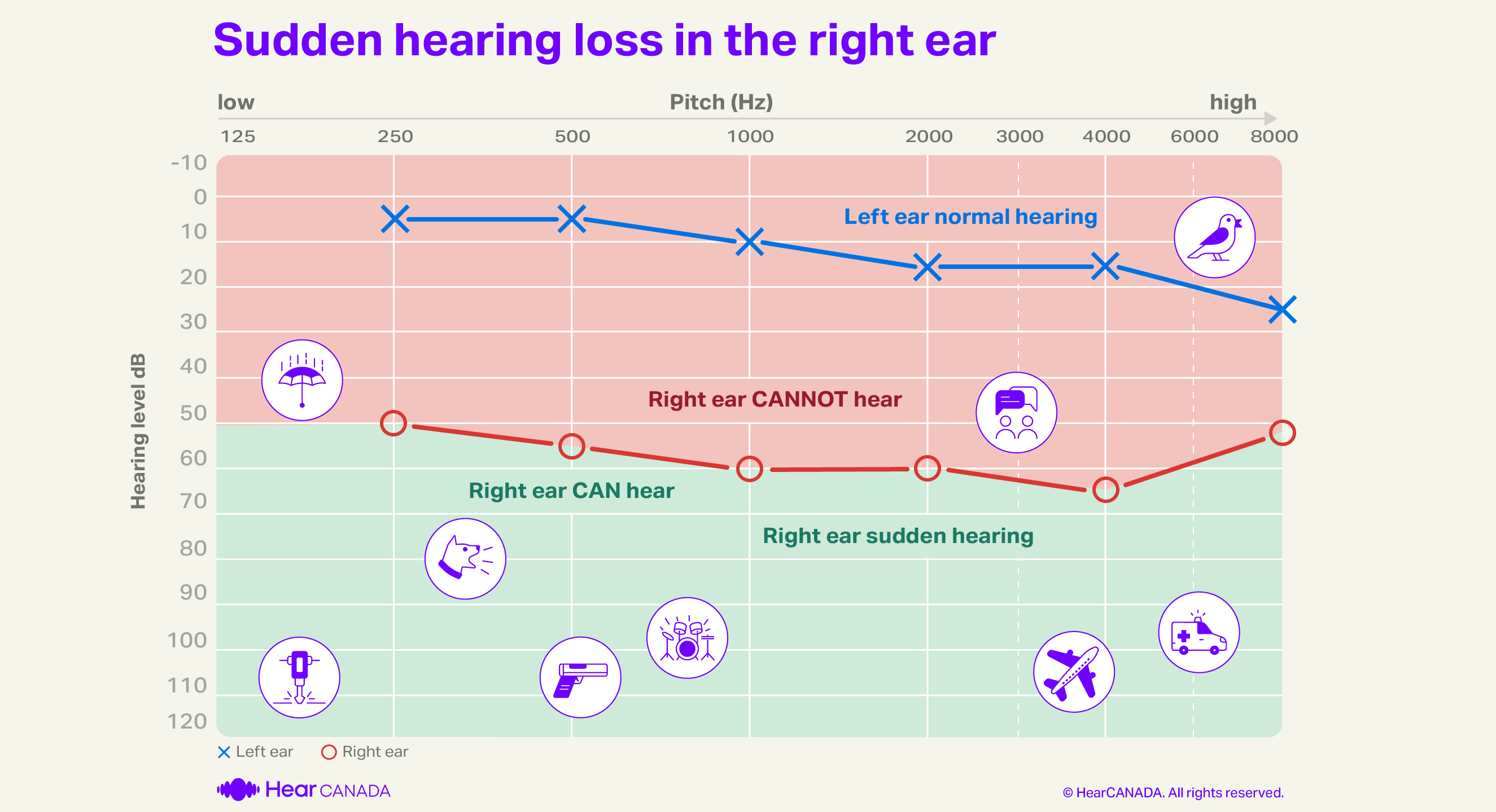 Sudden hearing loss audiogram