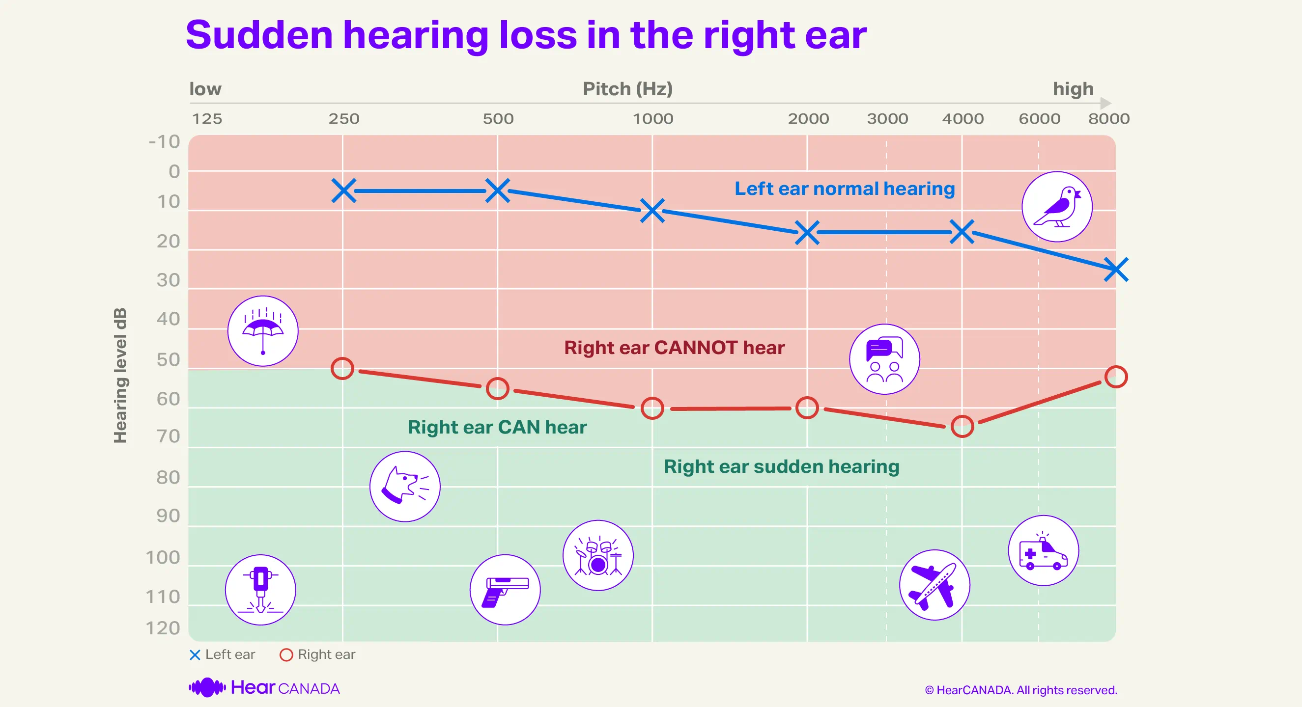 Sudden hearing loss audiogram