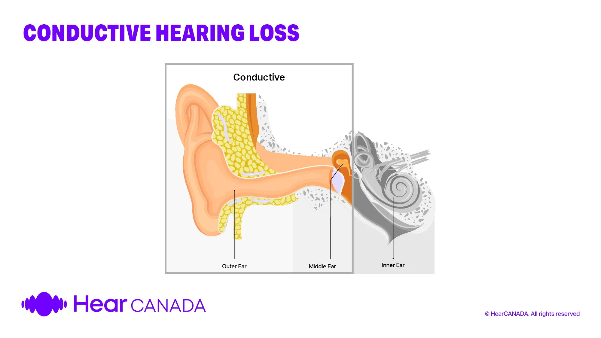 Conductive hearing loss