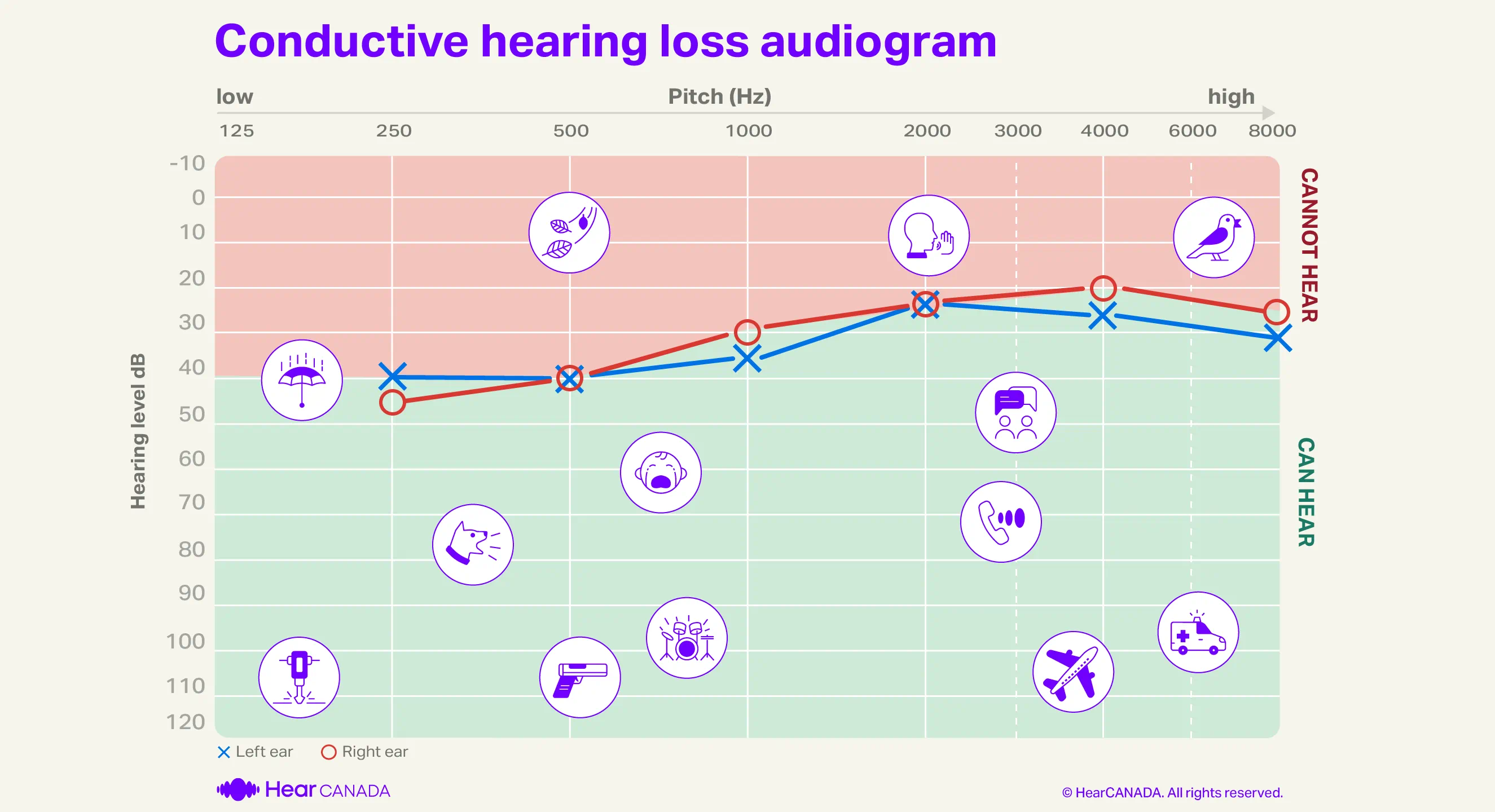 Audiogram conductive hearing loss