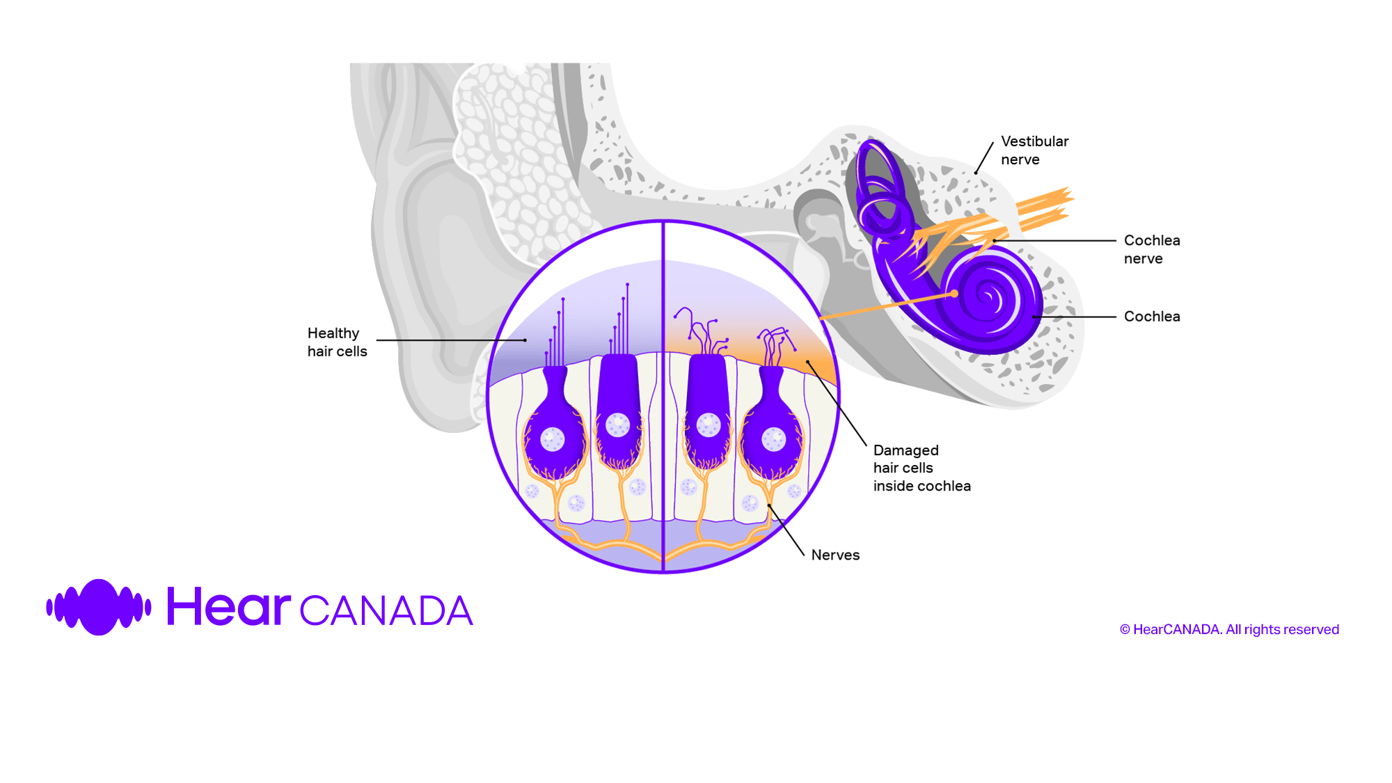Damaged hair cells hearing loss