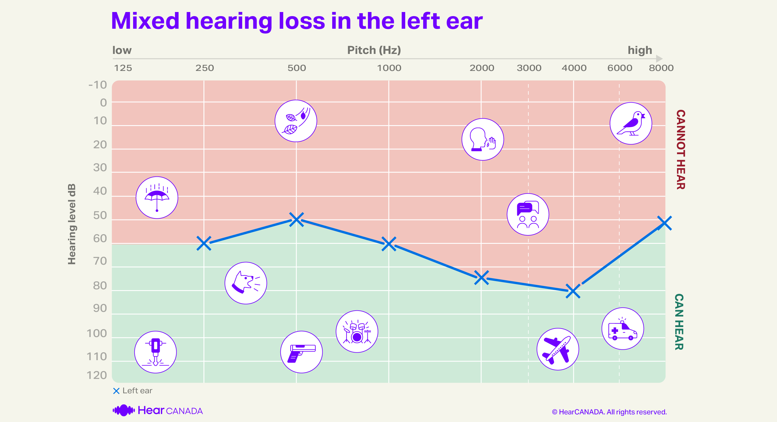 Mixed hearing loss