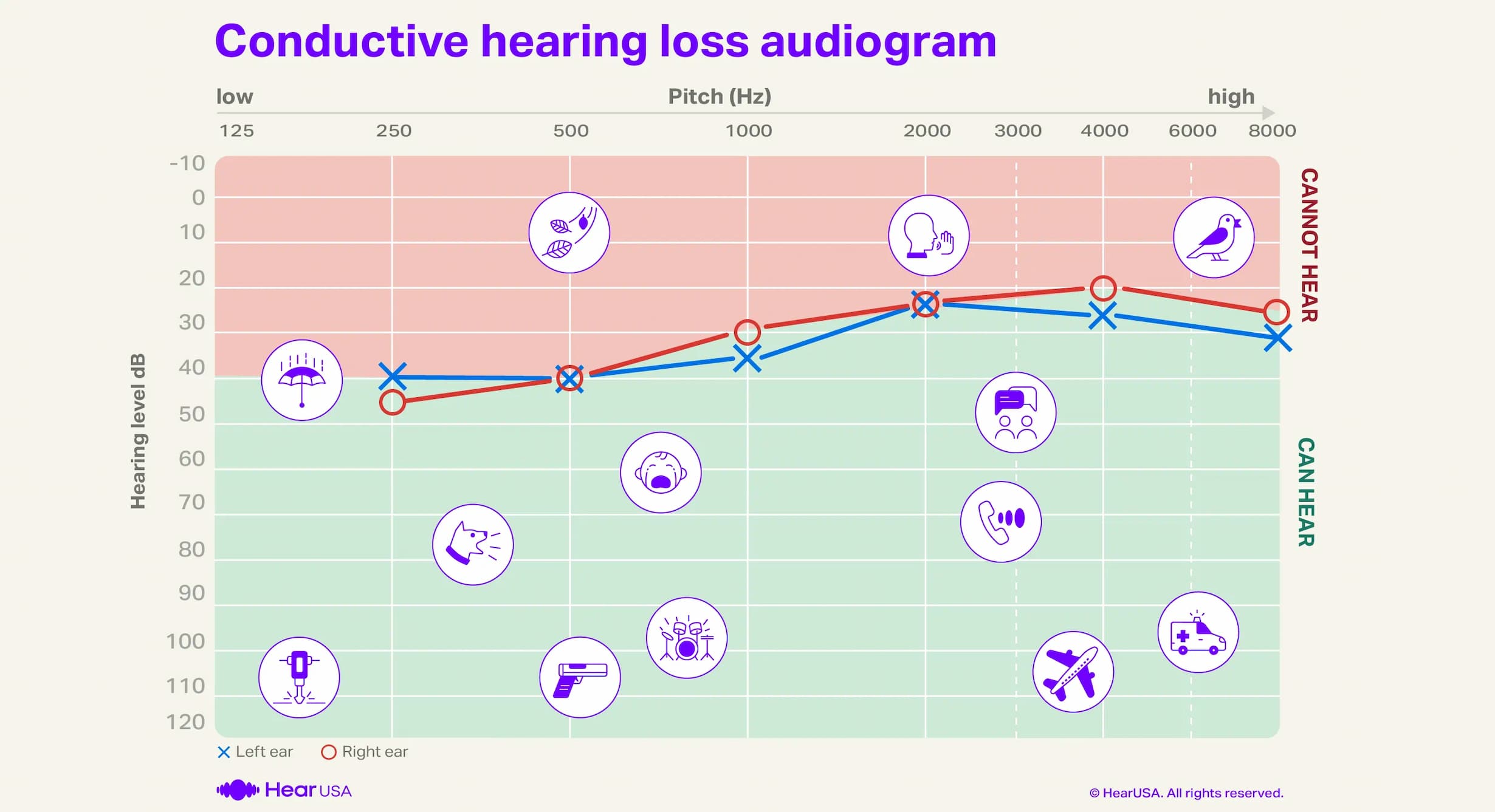 Conductive hearing loss audiogram