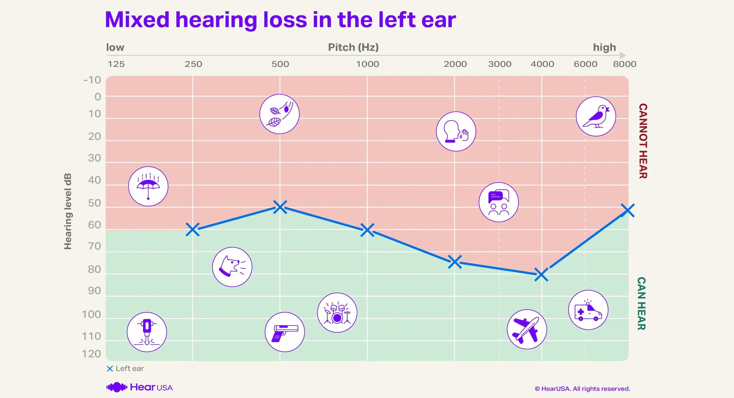 Mixed hearing loss audiogram