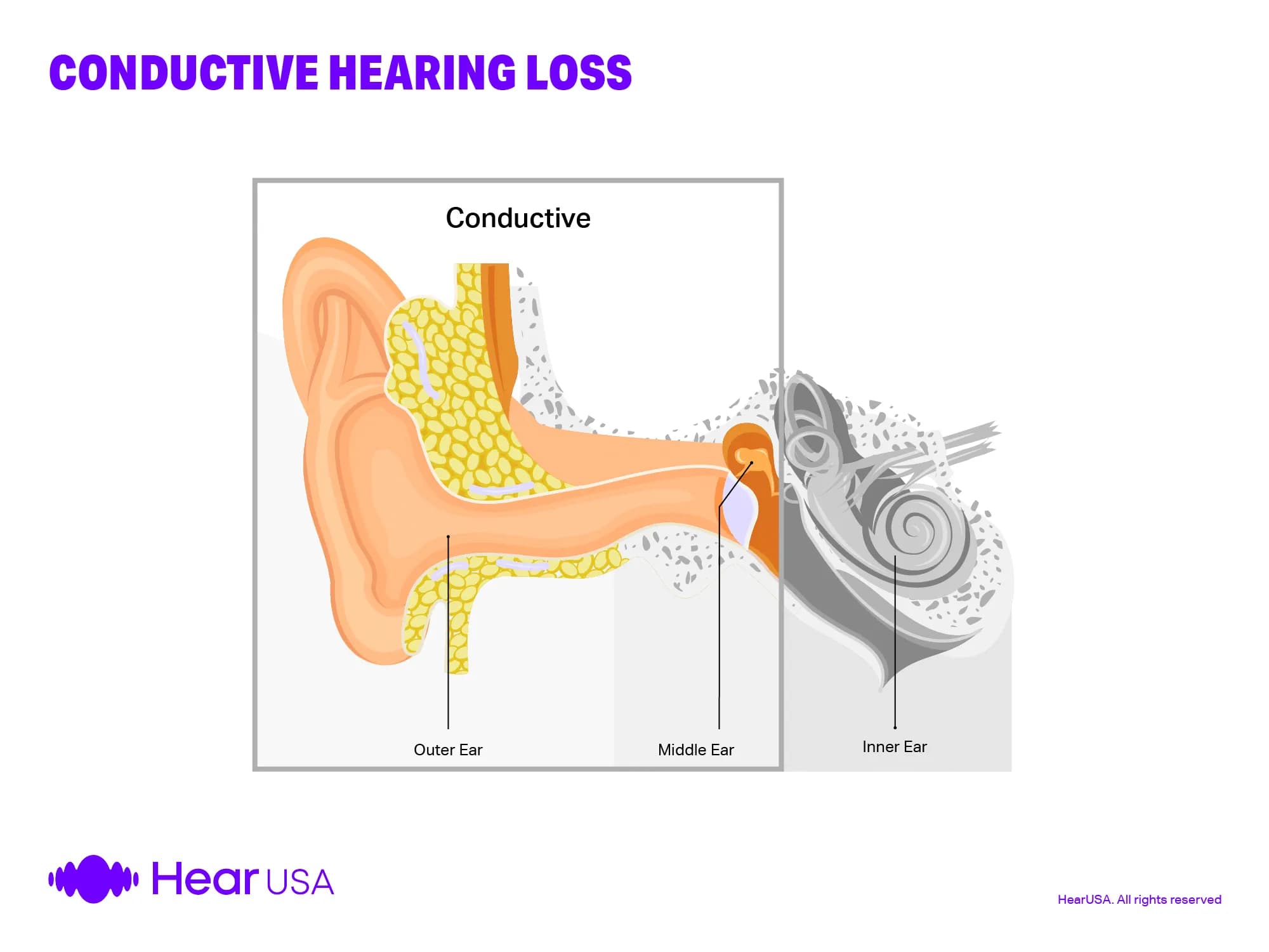 Conductive hearing loss is in the middle ear